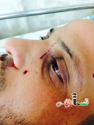 حيفا: قطعان من المتطرفين اليهود يعتدون على الشاب آدم الفقير (25 عاما) من قرية ابطن،